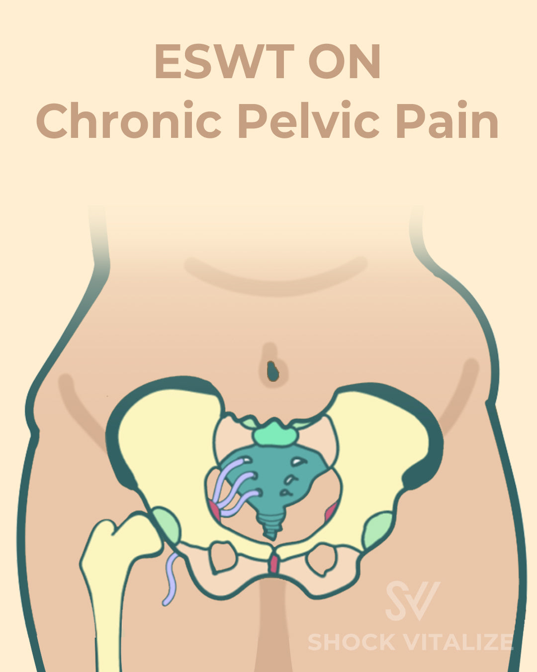SHOCKVITALIZE Your Pelvic Pain: Crush Chronic Pelvic Pain with ESWT Power