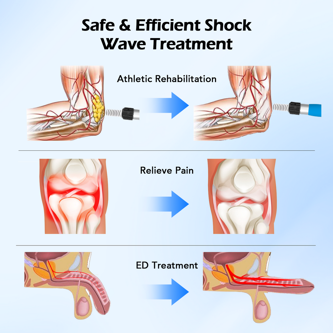 Healing Beyond the Surface: The Power of Extracorporeal Shock-Wave Therapy