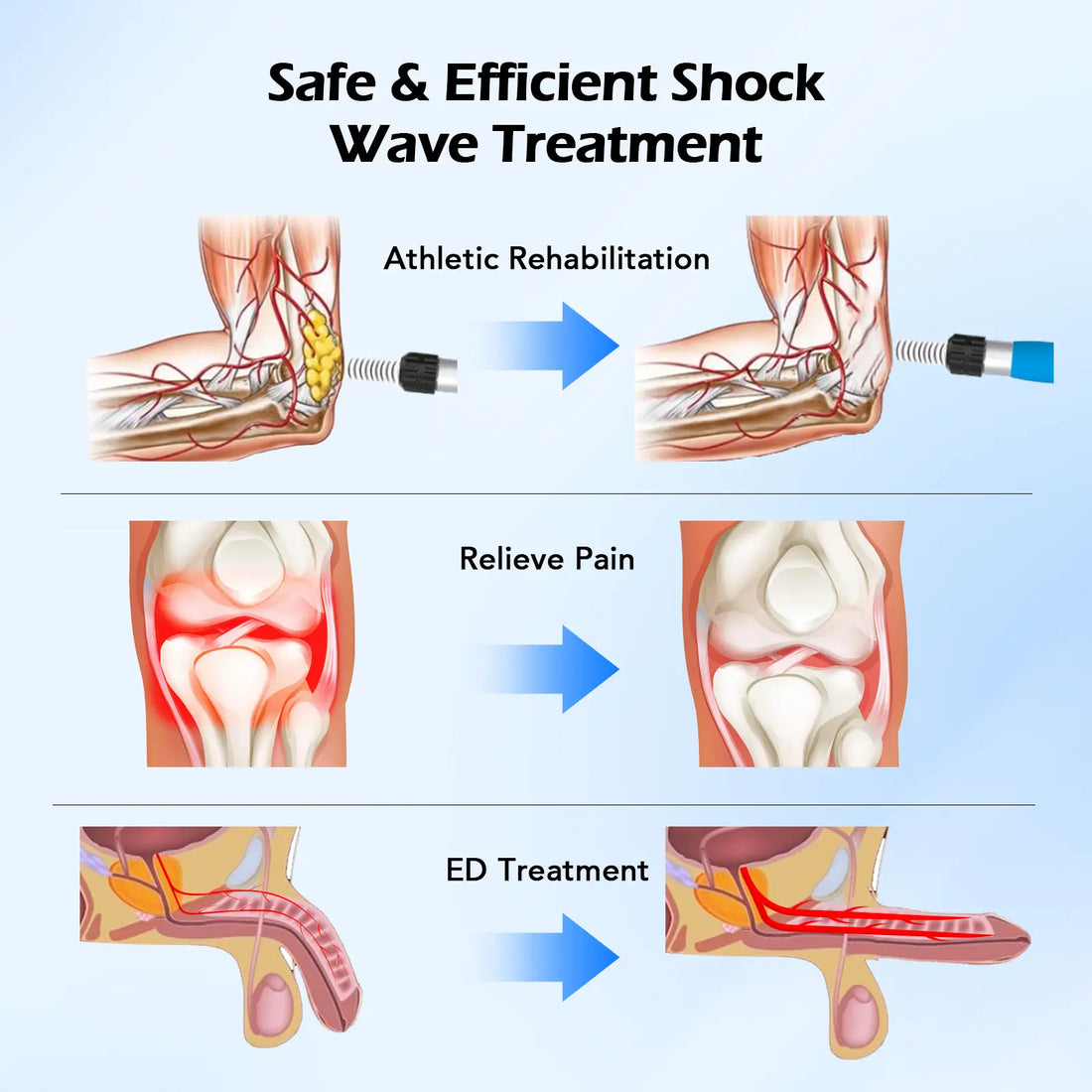 Healing Beyond the Surface: The Power of Extracorporeal Shock-Wave Therapy SHOCK VITALIZE